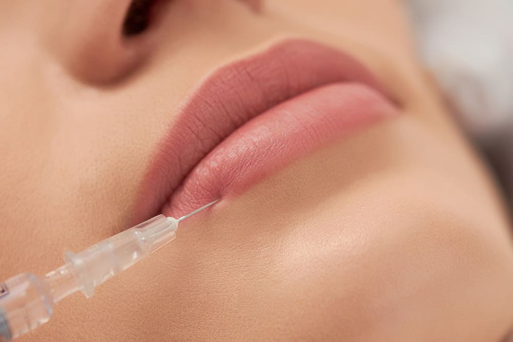Filler labbra a Parma