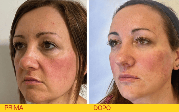 filler riempitivi