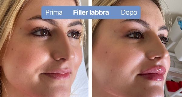 fillerlabbra1