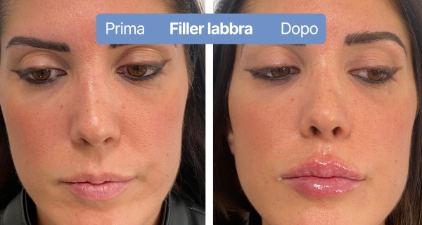 fillerlabbra2