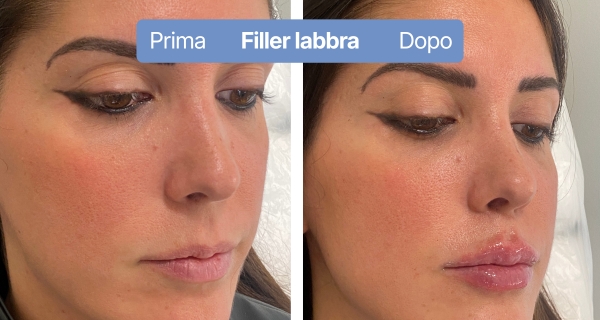 fillerlabbra3