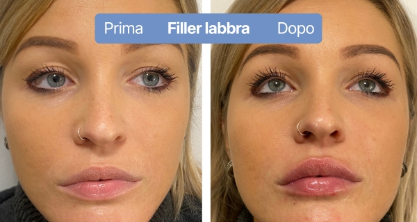 fillerlabbra4