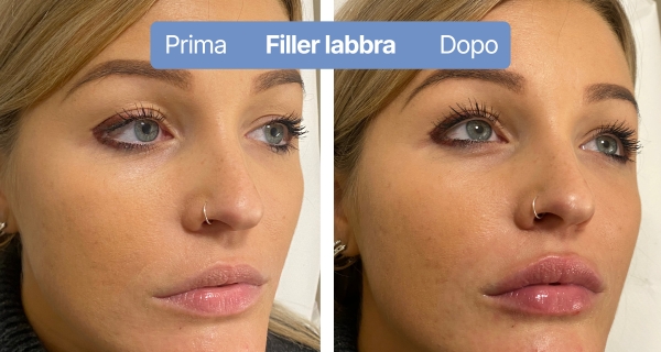 fillerlabbra5