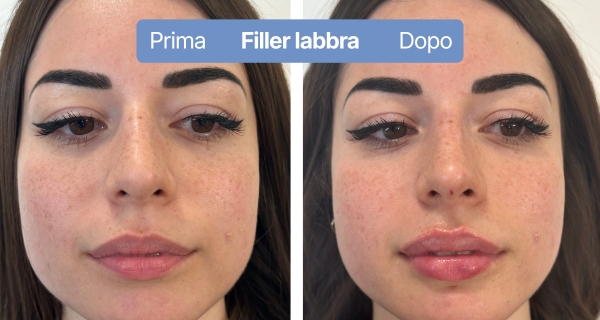 fillerlabbra6