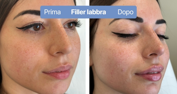 fillerlabbra7