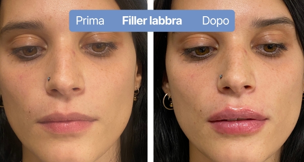 fillerlabbra8