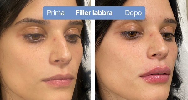 fillerlabbra9